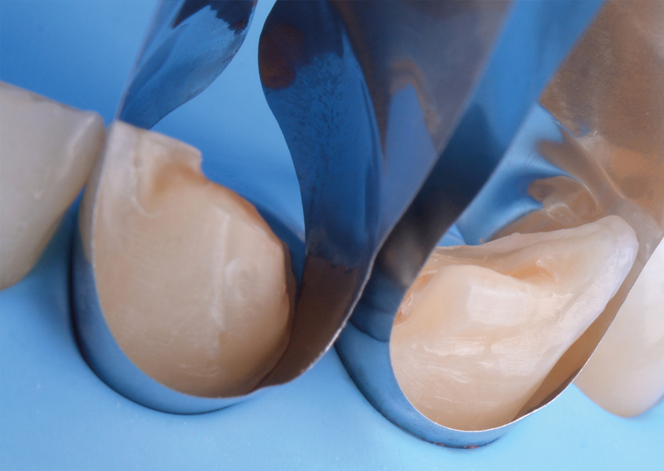 dr Lazar unica anterior dental matrix esthetics conservative dentistry