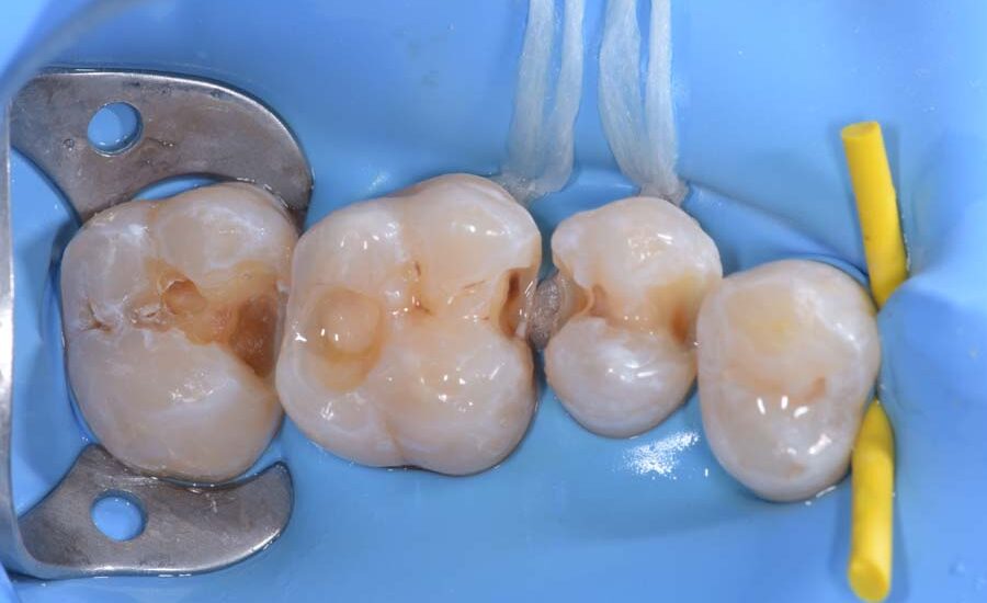 2 Restauro di Classe II sul primo molare