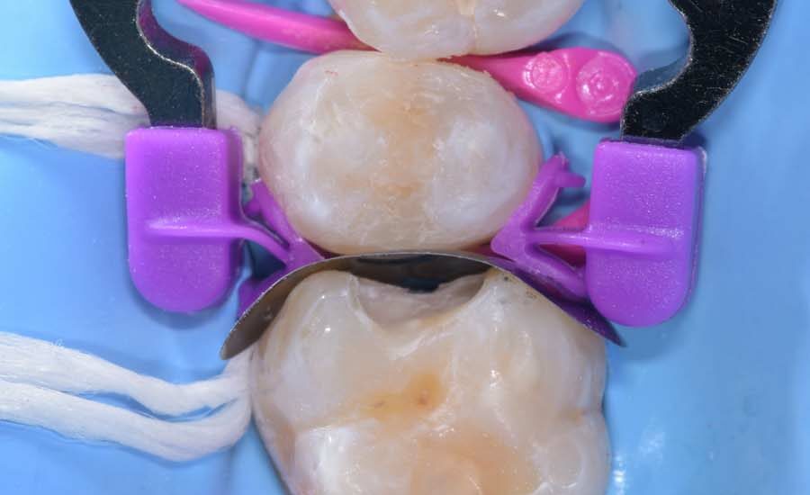 4Restauro di Classe II sul primo molare