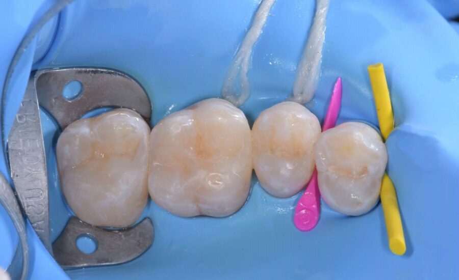 5 Class II restoration on first molar.jpeg
