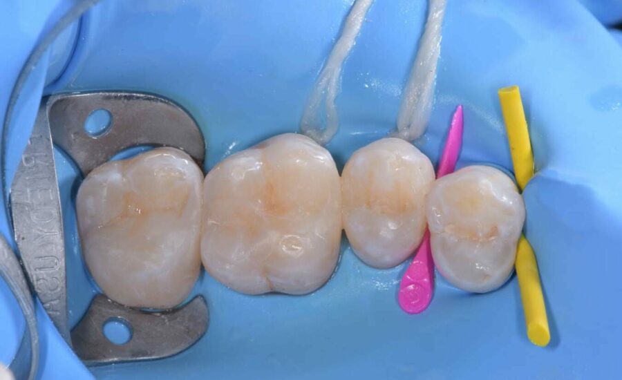 5 Restauro di Classe II sul primo molare