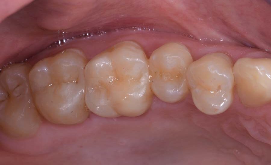 7 Class II restoration on first molar.jpeg