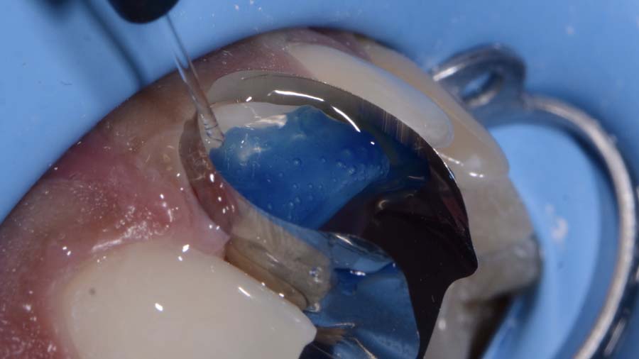 5 Post traumatic rehabilitation of incisors 11-21- Unica anterior - Prof. Gilbert Jorquera