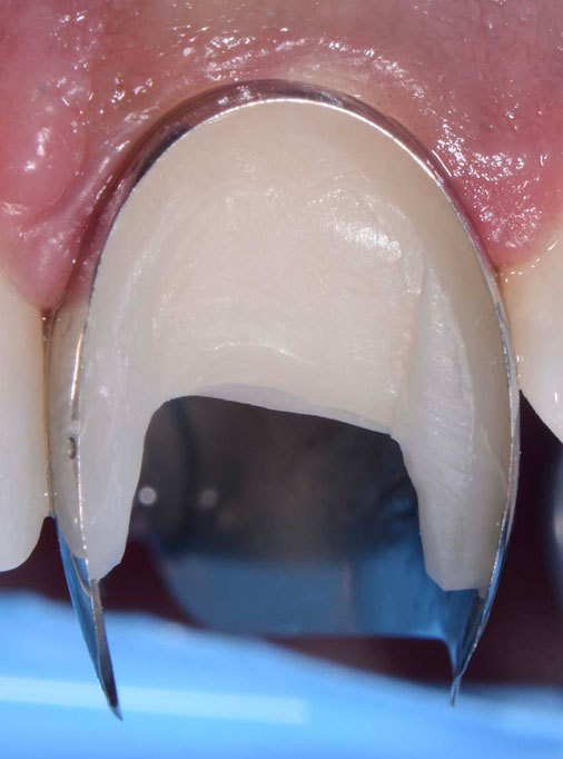 7 Post traumatic rehabilitation of incisors 11-21- Unica anterior - Prof. Gilbert Jorquera