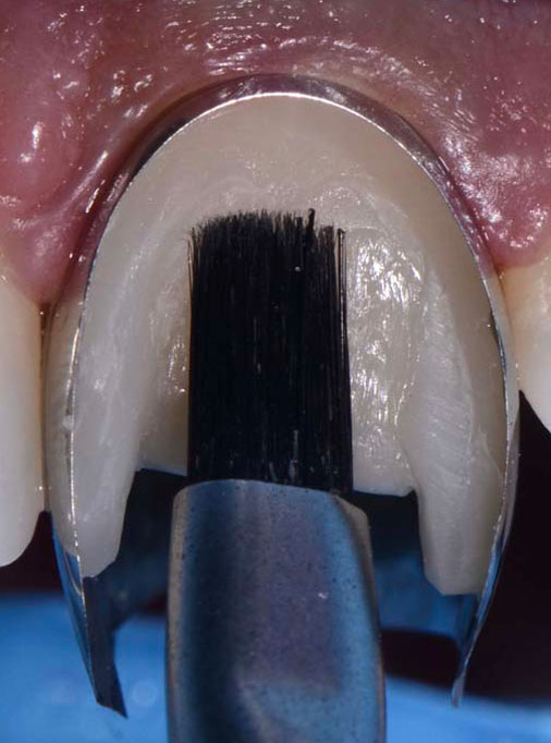 8 Post traumatic rehabilitation of incisors 11-21- Unica anterior - Prof. Gilbert Jorquera