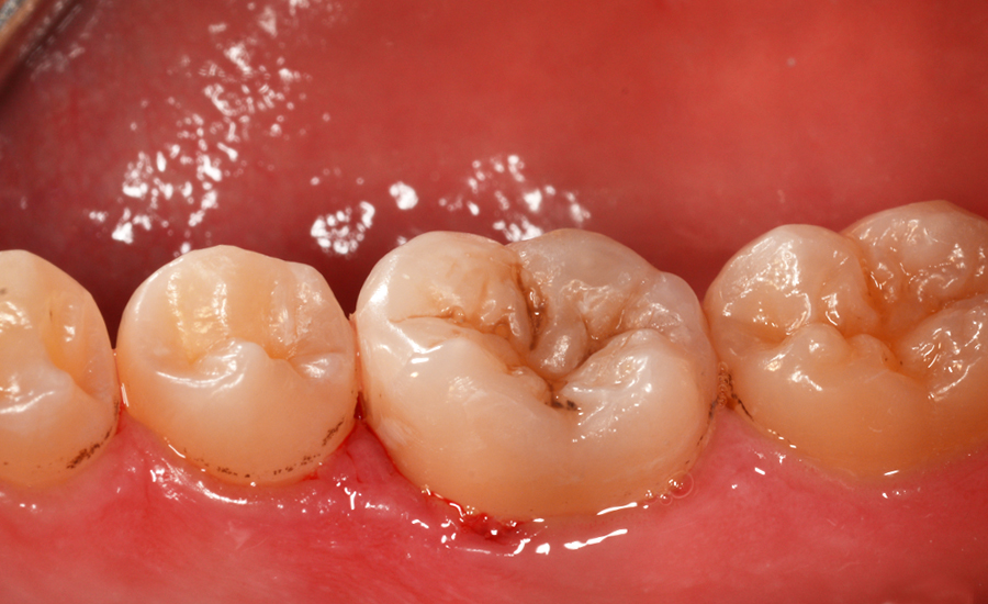 10 restauro di classe II di un giovane molare permanente con myQuickmat Forte sistema di matrici sezionali - Dr Papachroni