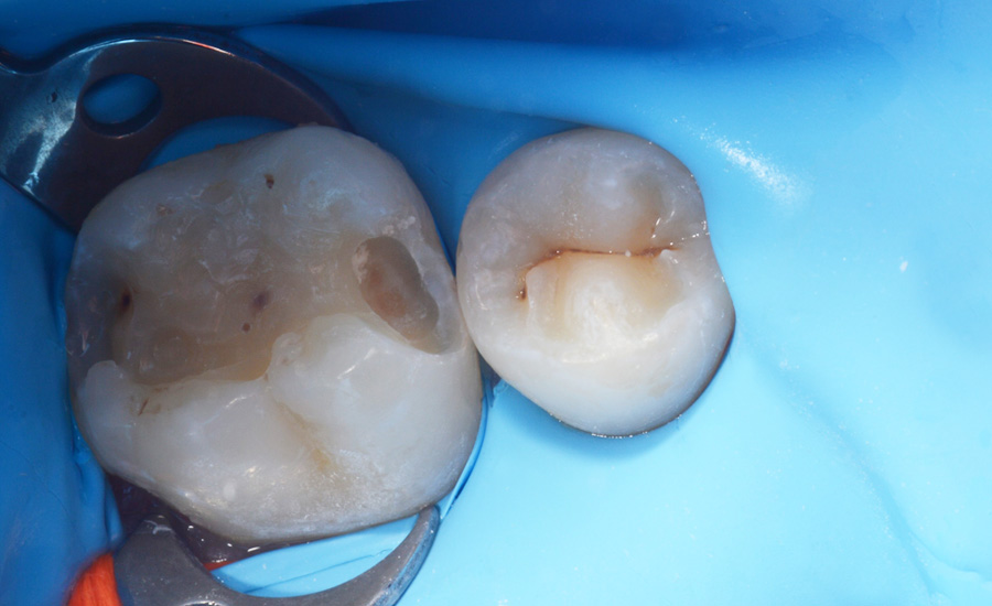 3 - Old composite replacement and Class II cavity direct restoration on young permanent molar with myQuickmat Forte sectional matrix system - Dr Marina Papachroni