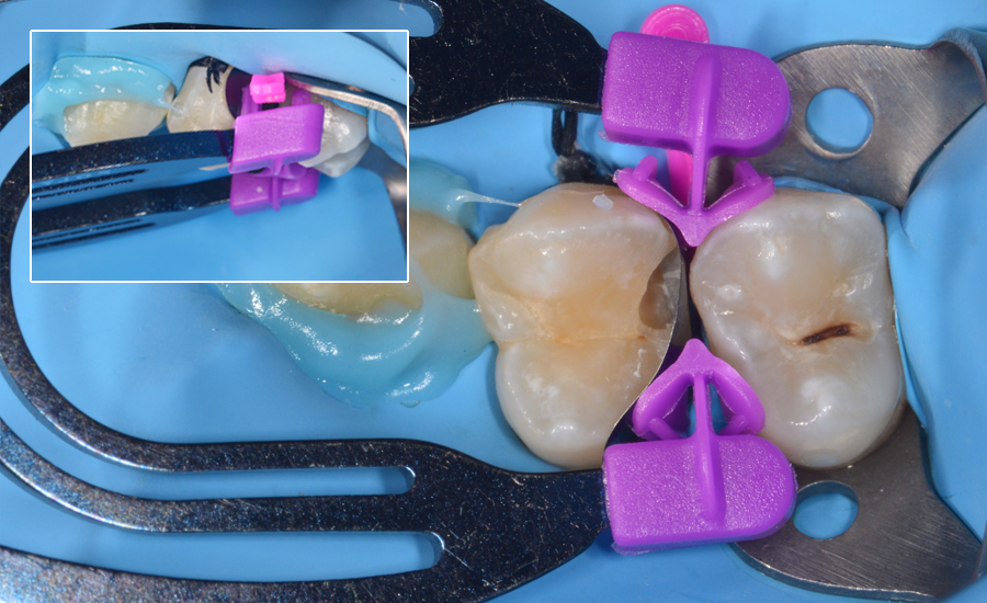 4 - Class II cavity direct composite restoration on a young permanent premolar with myClip 2.0 sectional matrix system - Dr Papachroni