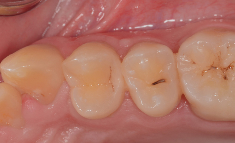 6 - Class II cavity direct composite restoration on a young permanent premolar with myClip 2.0 sectional matrix system - Dr Papachroni