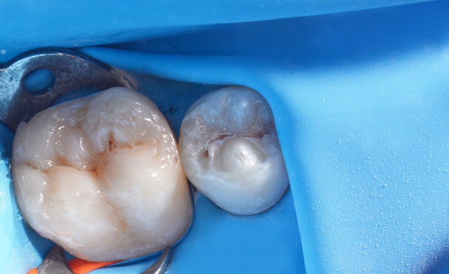 7 - Old composite replacement and Class II cavity direct restoration on young permanent molar with myQuickmat Forte sectional matrix system - Dr Marina Papachroni