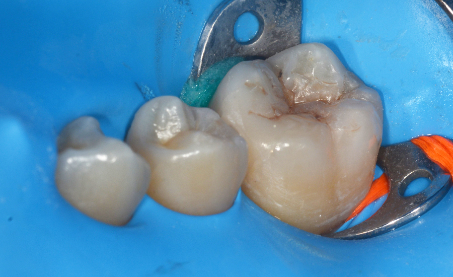 8 - class II restoration of a young permanent molar with myQuickmat Forte sectional matrix system - Dr Papachroni